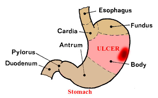 Stomach Ulcer Treatment Home Remedies