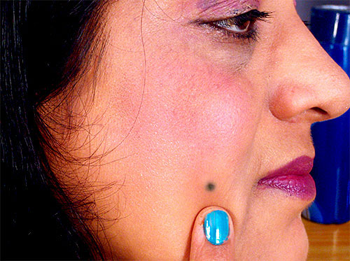 Beauty Mark Removal Home Remedies with Video