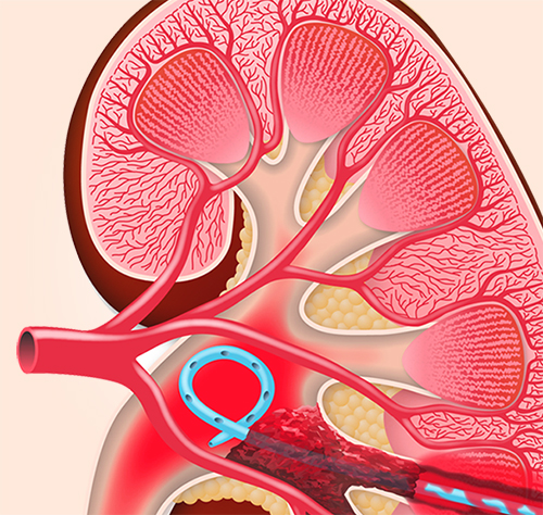 Kidney Stones Treatment 