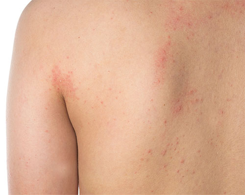 Eczema Treatment - Natural Home Remedies